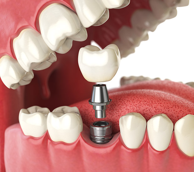 Columbus Will I Need a Bone Graft for Dental Implants