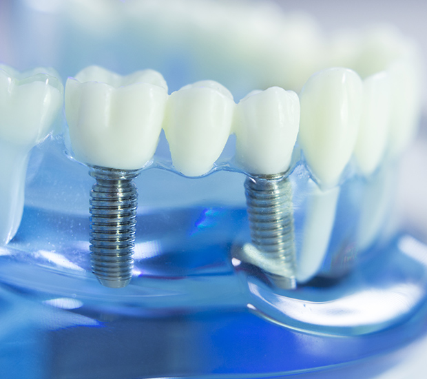 Columbus Dental Implants