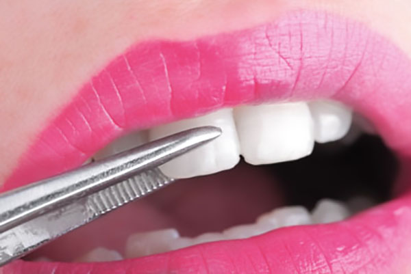 How Cosmetic Dentistry Can Fix Gaps Between Teeth